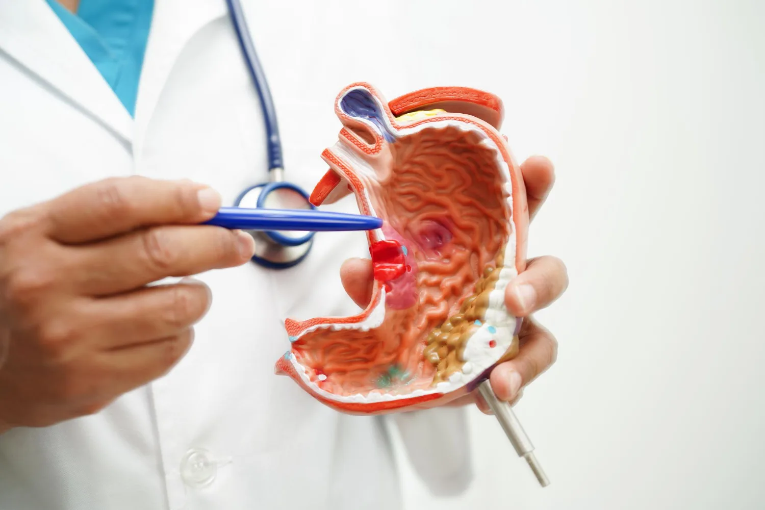 Gastrostomía endoscópica en CDMX: Procedimiento mínimamente invasivo para nutrición enteral